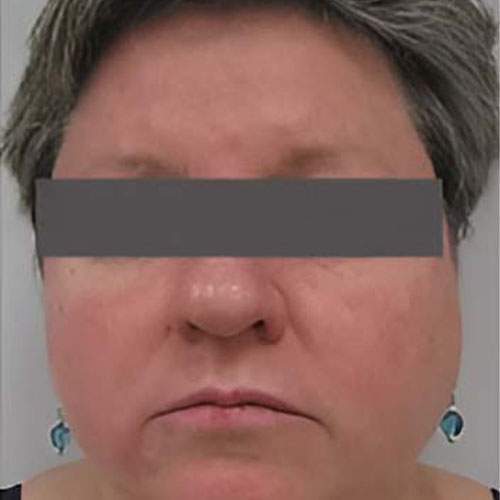 Traitement de la peau Saint-Jean-sur-Richelieu