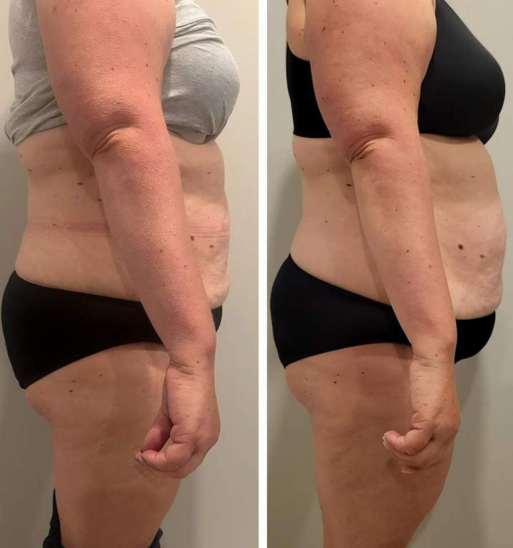 Traitement perte de poids Saint-Jean-sur-Richelieu