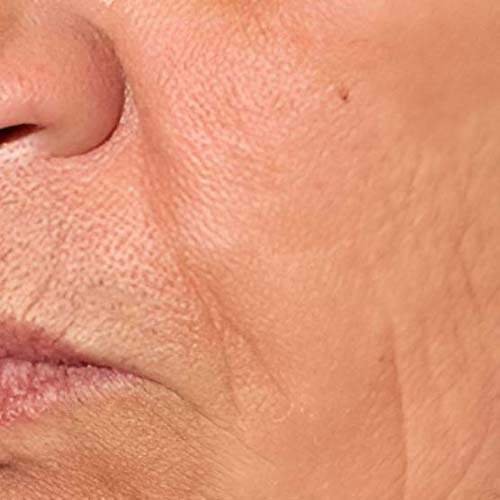 Traitement rajeunissement Saint-Jean-sur-Richelieu