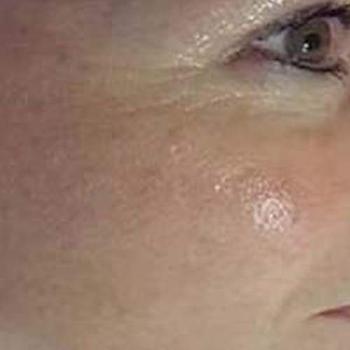 Traitement rajeunissement Saint-Jean-sur-Richelieu