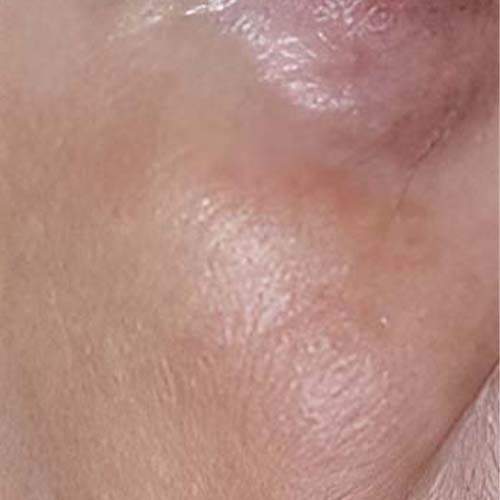 Soin de la peau Saint-Jean-sur-Richelieu