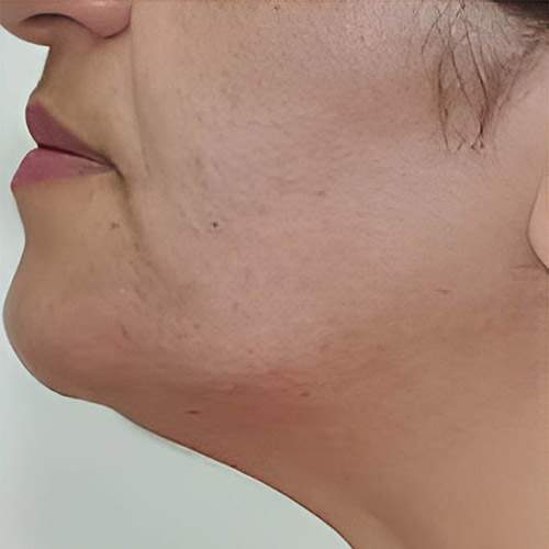 Traitement de la peau Saint-Jean-sur-Richelieu