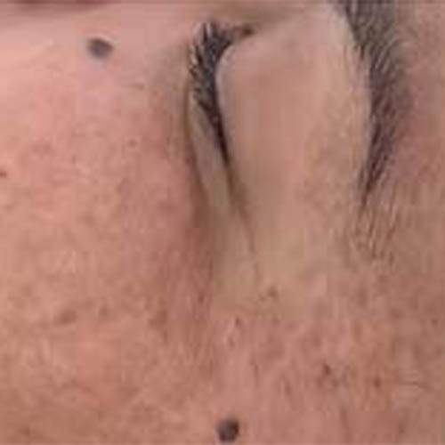 Soin de la peau Saint-Jean-sur-Richelieu